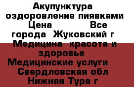 Акупунктура, оздоровление пиявками › Цена ­ 3 000 - Все города, Жуковский г. Медицина, красота и здоровье » Медицинские услуги   . Свердловская обл.,Нижняя Тура г.